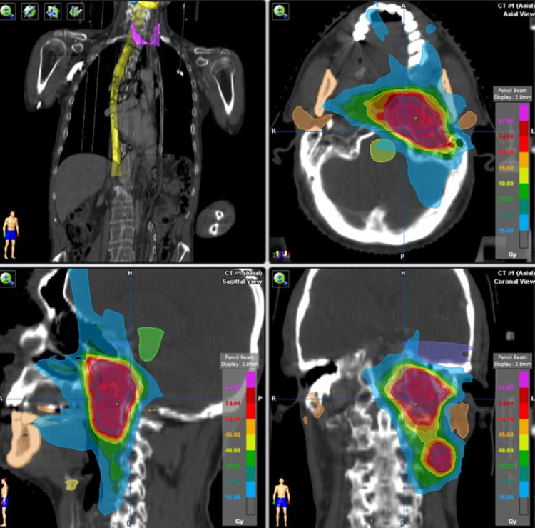 PET TAC EN ONCOLOGÍA RADIOTERÁPICA | NPunto